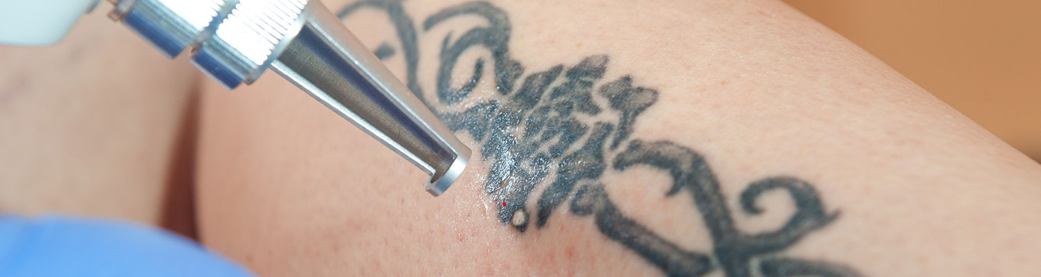 laser tattoo removal in Mumbai