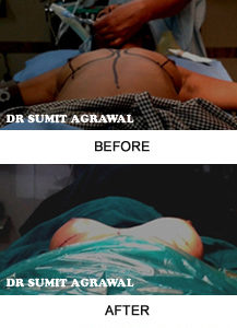 breast enlargement surgery Mumbai