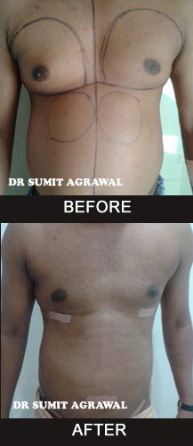 Stomach Liposuction or Abdominal Liposuction