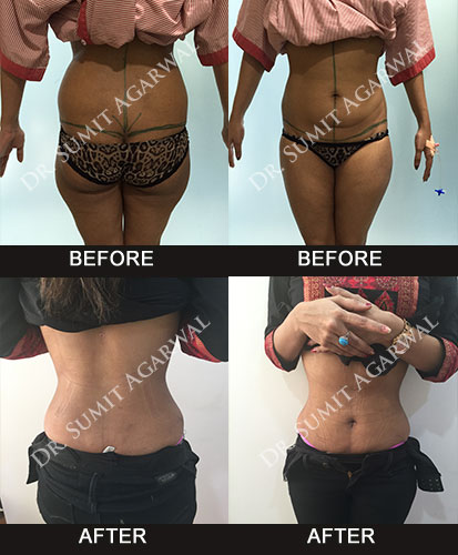 Liposuction Surgery