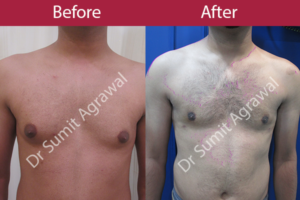 Gynecomastia Surgery and Treatment In Mumbai