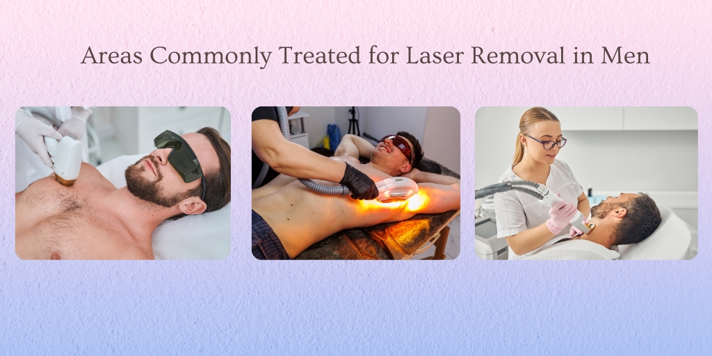 Areas Commonly Treated for Laser Removal in Men