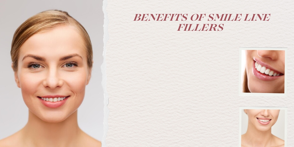 Benefits of Smile Line Fillers