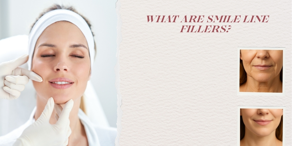 What Are Smile Line Fillers?