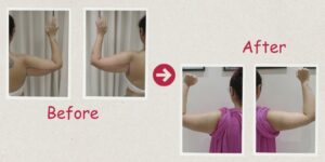Arm-Liposuction