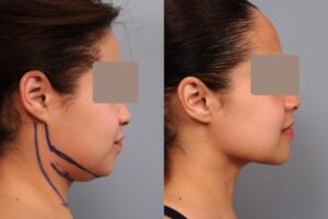 Chin-Liposuction