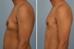 Gynecomastia-Surgery