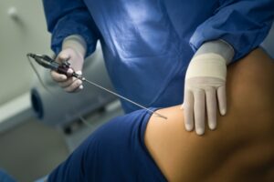 Liposuction-in-Mumbai