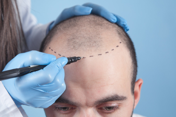 FUE Hair Transplant