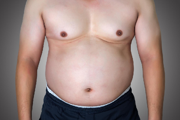 Gynecomastia