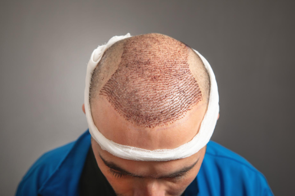High-Density Hair Transplant