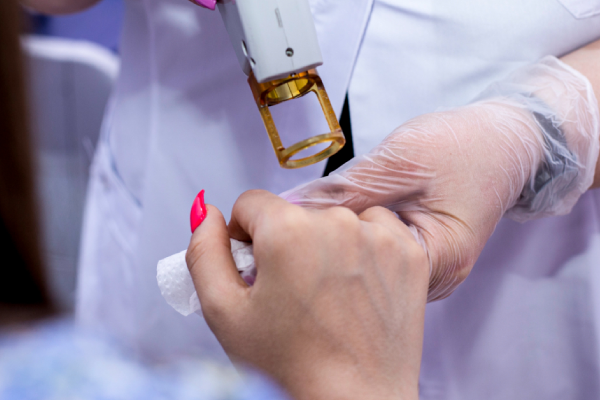 Laser Tattoo Removal