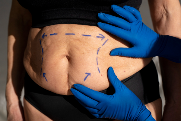 Liposuction Surgery