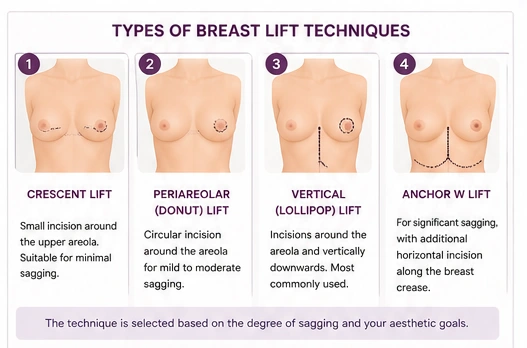 Types of Breast Lift Techniques