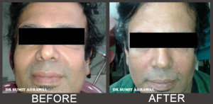 Dermal filler for Nasolabial fold / Smile Line