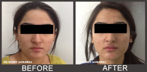 Nasolabial Folds Treatment