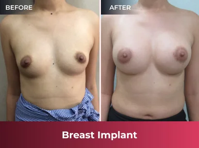 breas-t implant before & after