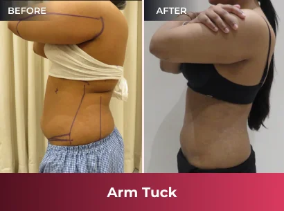Liposuction Before & After 2