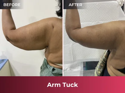 Liposuction Before & After 3