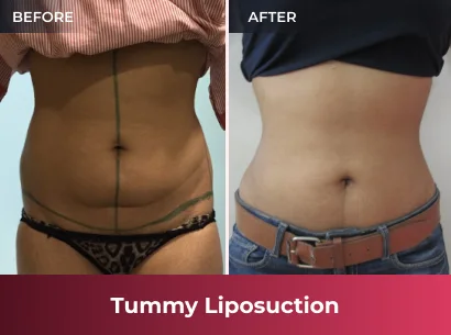Tummy Tuck Liposuction